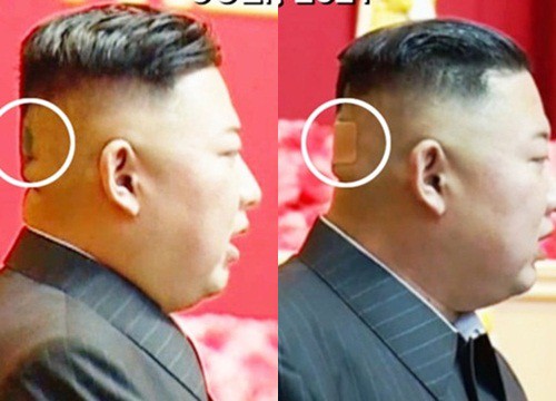 Kim Jong-un dán băng y tế sau đầu