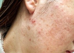 Bỏ túi bí kíp hỗ trợ phục hồi da nhiễm corticoid tại nhà mùa dịch