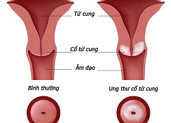 Những biến chứng nguy hiểm của ung thư cổ tử cung