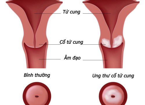 Những biến chứng nguy hiểm của ung thư cổ tử cung