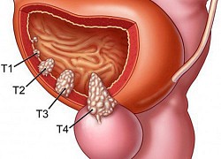 Tiểu ra máu cảnh báo ung thư bàng quang