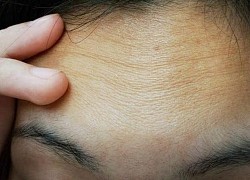 7 cách để loại bỏ và ngăn ngừa nếp nhăn trên trán