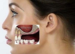 Giải thích nguyên nhân niềng răng bị hóp má và cách khắc phục