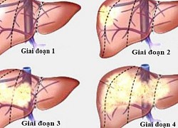 Có các triệu chứng này ung thư gan đã ở giai đoạn muộn