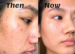 Hơn 14 nghìn người trên Sephora "thả tim" cho tuýp kem trị thâm mụn, sưng đỏ này, không thử là phí bạn ơi!