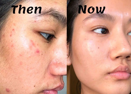 Hơn 14 nghìn người trên Sephora "thả tim" cho tuýp kem trị thâm mụn, sưng đỏ này, không thử là phí bạn ơi!