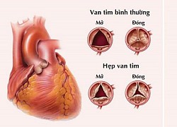 Khi nào người thay van tim hai lá nên đi khám?