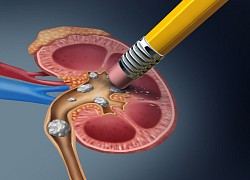 8 cách giúp bạn ngăn ngừa sỏi thận