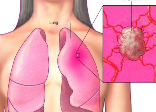 10 bệnh ung thư phổ biến thường không có triệu chứng sớm