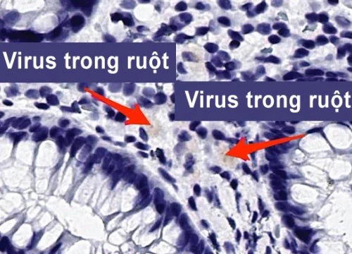 Cô bé 11 tuổi vẫn có virus nCoV trong ruột sau 3 tháng nhiễm bệnh