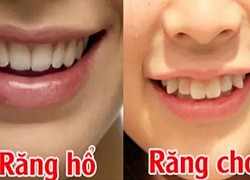 Nhìn tướng răng biết bạn là tỷ phú tương lai hay nông dân trọn kiếp?