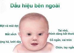 Trẻ em sinh ra từ quan hệ cận huyết thống có nguy cơ mắc bệnh gì?