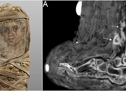 Xác ướp Ai Cập có vết thương băng bó hé mở bí mật y học cổ đại