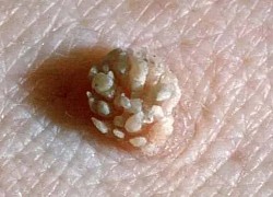 Cô gái 29 tuổi bị nổi mụn "súp lơ" ở vùng kín, bác sĩ chẩn đoán nhiễm virus HPV do những thói quen gần gũi chồng rất tai hại