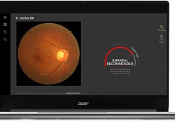 Acer ra mắt Giải pháp tầm soát bệnh võng mạc tiểu đường VeriSee DR dùng công nghệ AI