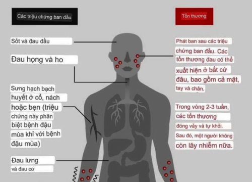 5 lý do để không nên quá hoang mang về bệnh đậu mùa khỉ