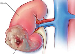 Triệu chứng ung thư thận nhiều người bỏ qua