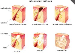 Một số lưu ý khi dùng thuốc trị mụn trứng cá