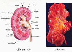 Viêm thận bể thận cấp: Dấu hiệu nhận biết sớm và các phương pháp điều trị