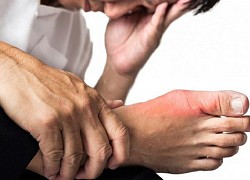 7 nhận thức sai lầm trong điều trị bệnh gout cần tránh