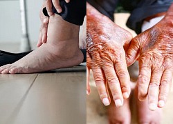 5 dấu hiệu trên da cảnh báo bạn đang gặp vấn đề về thận
