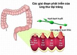 Ung thư đại trực tràng ngày càng trẻ hóa, dưới đây là yếu tố nguy cơ khiến nhiều người mắc phải căn bệnh này