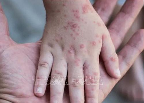 EU mua 110.000 liều vaccine ngừa bệnh đậu mùa khỉ