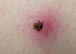 Hơn 14% số người tham gia nghiên cứu mắc bệnh Lyme do bị bọ chét cắn