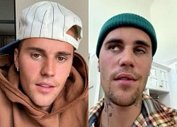 Justin Bieber liệt nửa mặt, chuyên gia lên tiếng về tình trạng của nam ca sĩ