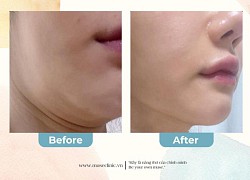 Top 3 liệu trình tạo hình V-Line Hàn Quốc với thẩm mỹ viện Muse Clinic