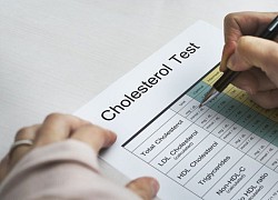 Chuyên gia: Các triệu chứng cholesterol cao cần theo dõi