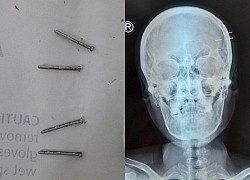 Tự bắn 4 cây đinh vào hộp sọ để giải sầu