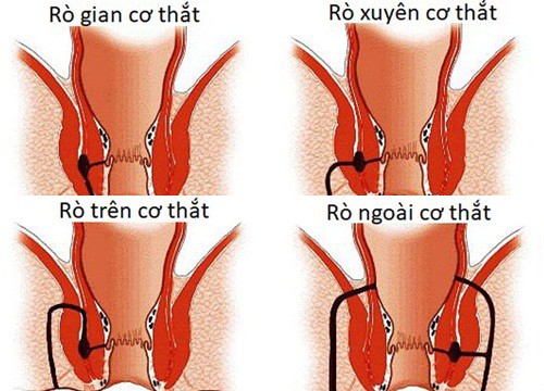 Nhận biết và cách trị bệnh mạch lươn