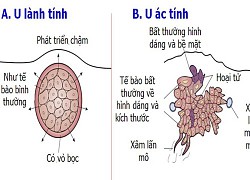 Thuộc lòng những biểu hiện của khối u ác tính này để đi khám ngay kẻo muộn