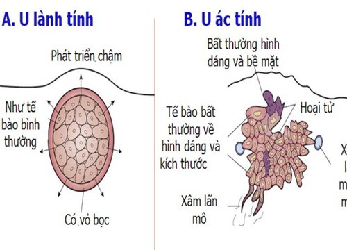 Thuộc lòng những biểu hiện của khối u ác tính này để đi khám ngay kẻo muộn