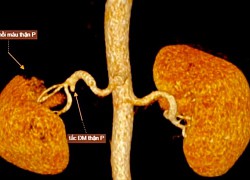 Đau bụng có thể là triệu chứng của bệnh nhồi máu thận