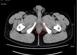 Đi khám sức khỏe tổng quát, phát hiện xương cá đâm thủng thành ruột