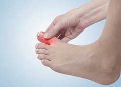 Bị gout ở tuổi 26