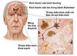 Hãy nhận biết sớm để điều trị hiệu quả bệnh mất trí nhớ Alzheimer