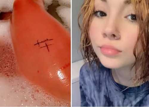 Kỳ lạ cô gái dị ứng nước, đụng vào là nổi mề đay