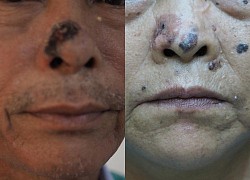 TP.HCM: Gia tăng số người cao tuổi bị ung thư da