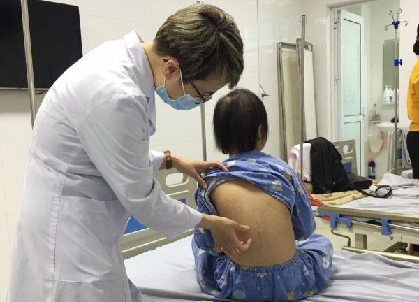 Cảnh giác với bệnh viêm da cơ địa ở trẻ nhỏ khi thời tiết lạnh và hanh khô