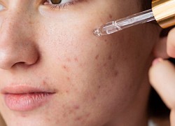 Cần làm gì nếu da bị đẩy mụn khi dùng retinol?