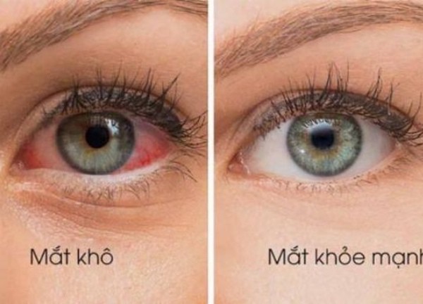 5 bài thuốc giúp giảm các triệu chứng khô mắt