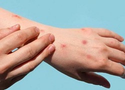 Đậu mùa khỉ có cách lây gần giống HIV