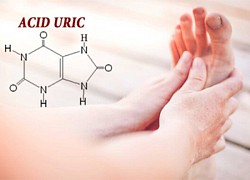 6 cách giảm acid uric máu liên quan đến bệnh gout