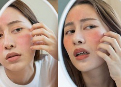 Điều gì có thể xảy ra nếu sử dụng quá liều retinol?