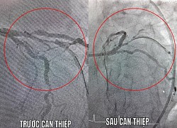 Bệnh nhân ngừng tim được hồi sinh ngoạn mục