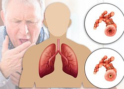 Bệnh phổi tắc nghẽn mạn tính (COPD): Nóng lạnh đan xen dễ bùng phát các đợt cấp của COPD