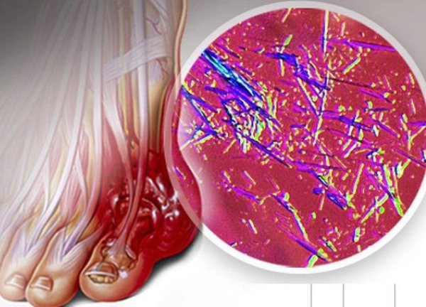 Khi nào cần xét nghiệm acid uric?